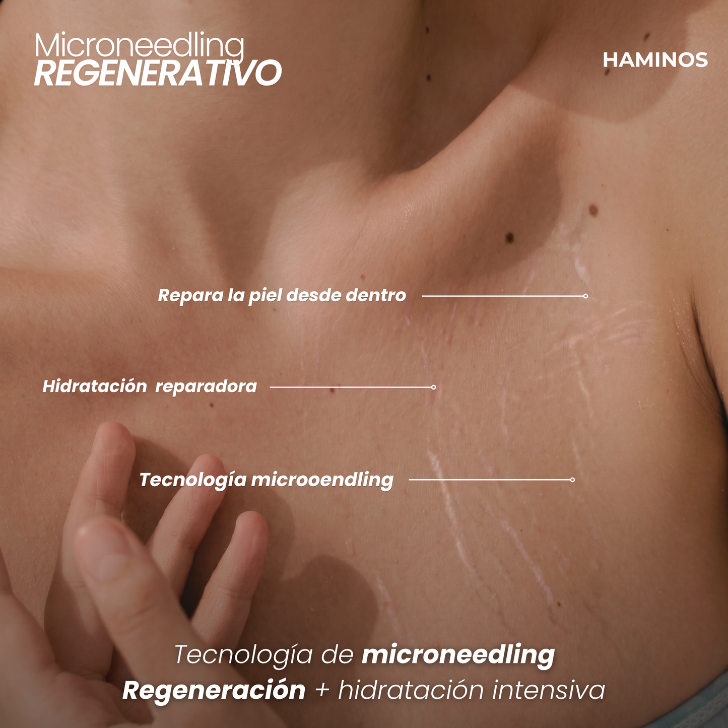 Derma Stamp Antiestrías | Microneedling con Ácido Hialurónico
