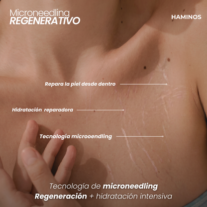 Derma Stamp Antiestrías | Microneedling con Ácido Hialurónico