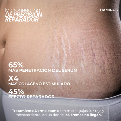 Tratamiento antiestrías con derma stamp