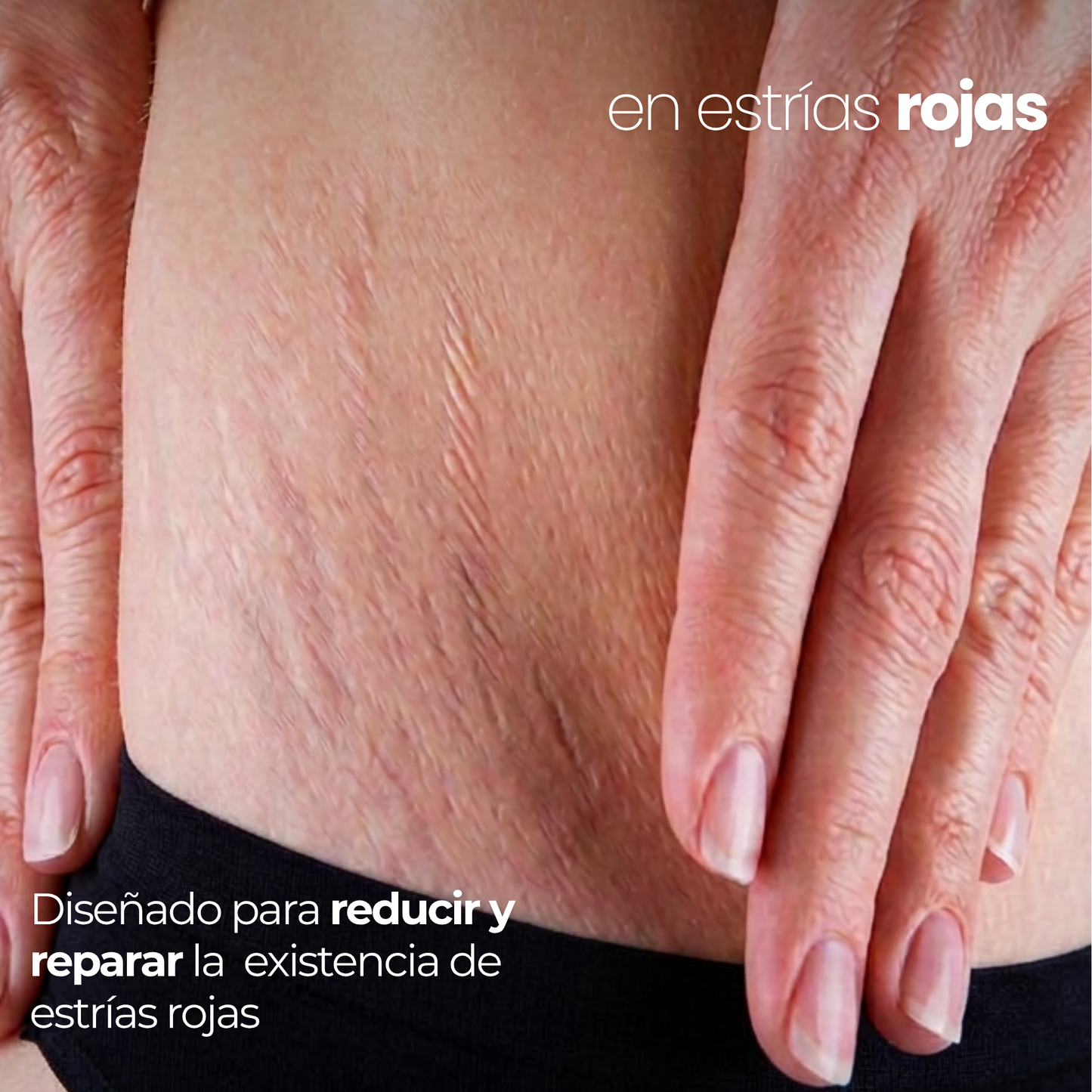 Derma Stamp Antiestrías | Microneedling con Ácido Hialurónico