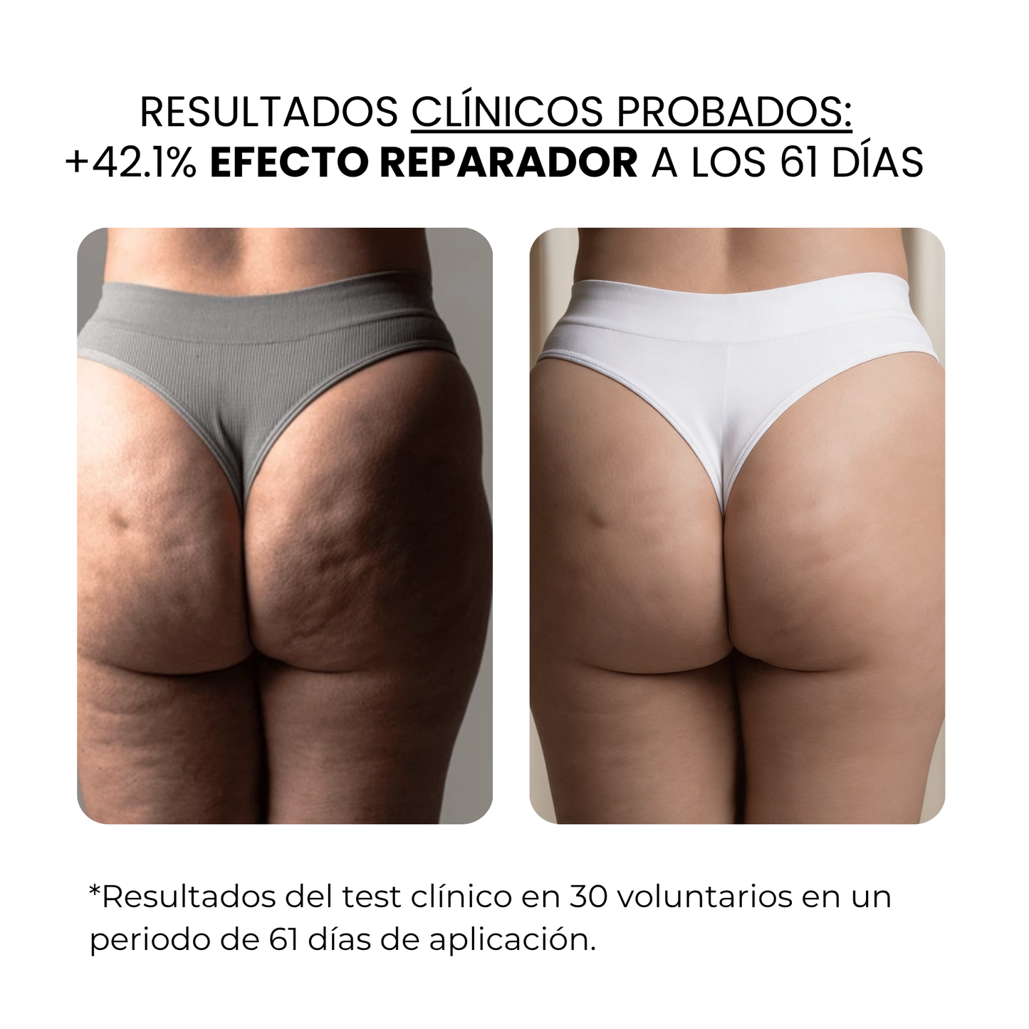 Derma Stamp Antiestrías | Microneedling con Ácido Hialurónico