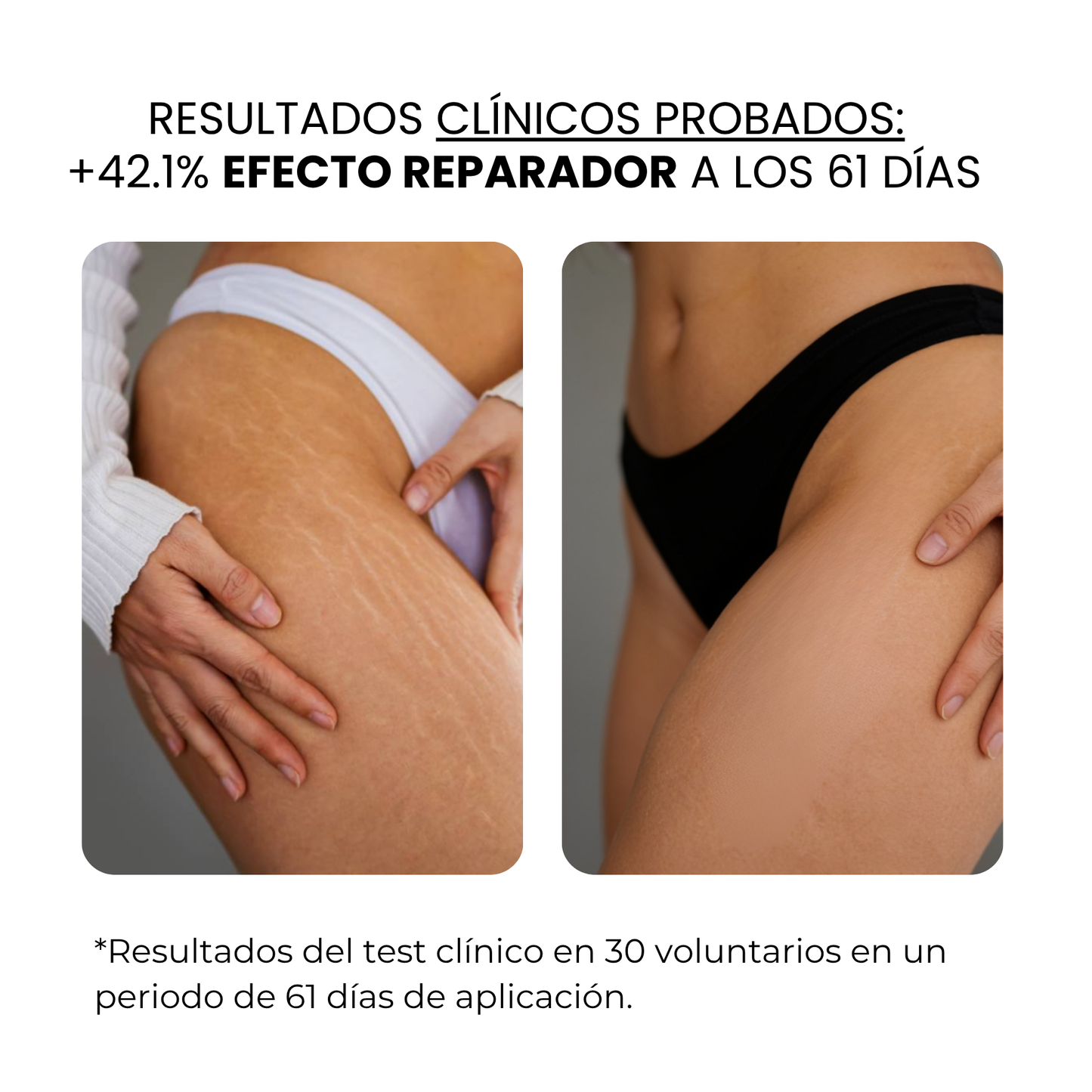 Derma Stamp Antiestrías | Microneedling con Ácido Hialurónico