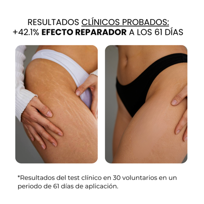 Derma Stamp Antiestrías | Microneedling con Ácido Hialurónico
