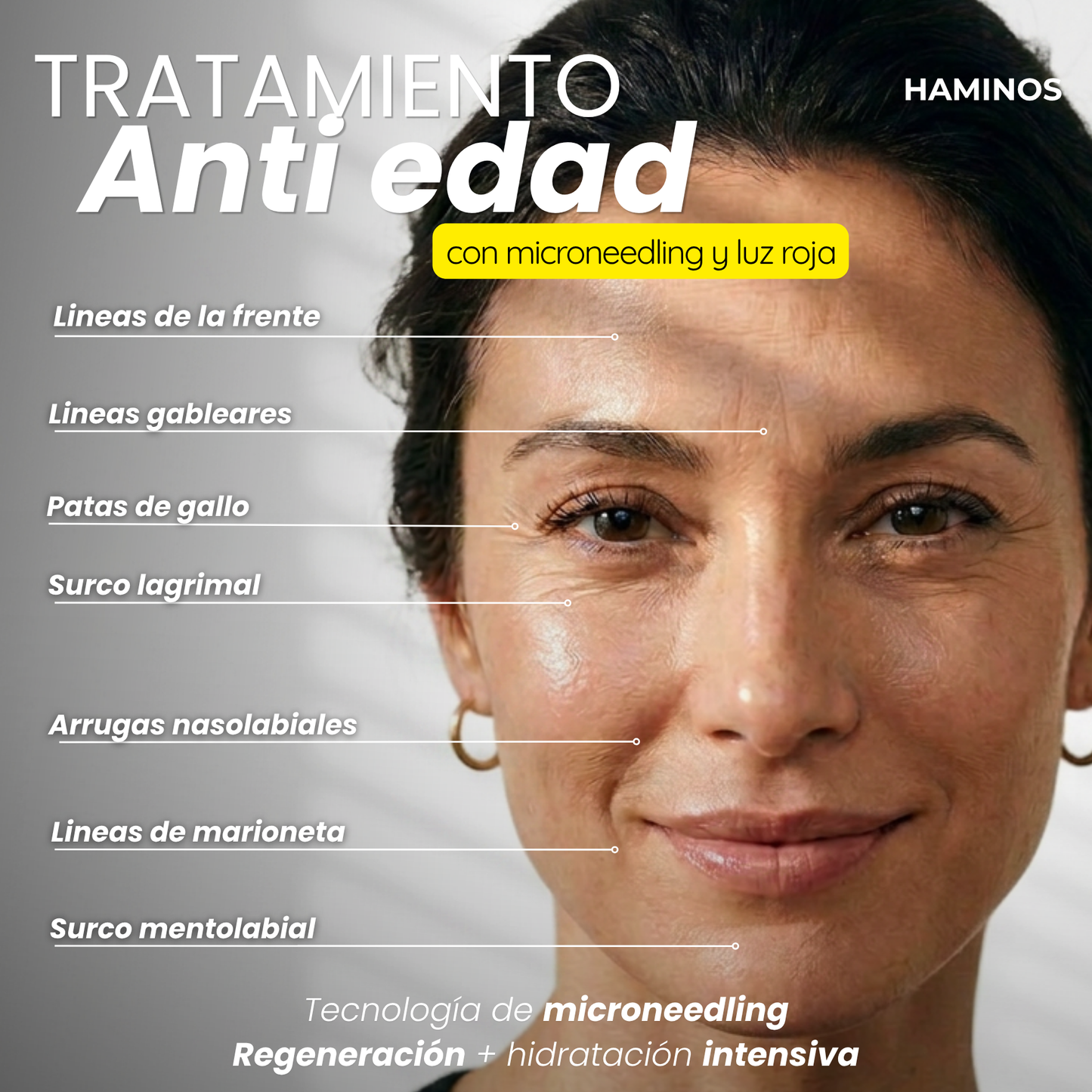 Derma Stamp Antiedad | Microneedling con Ácido Hialurónico