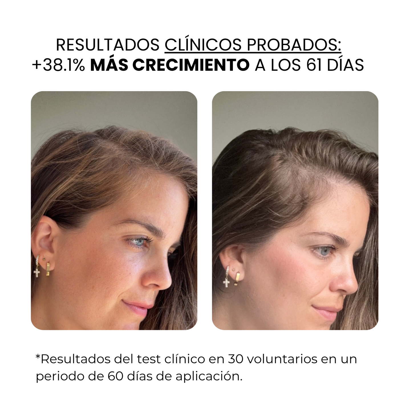 Derma Stamp Crecimiento Capilar Femenino | Microneedling con Sérum Hair Growth