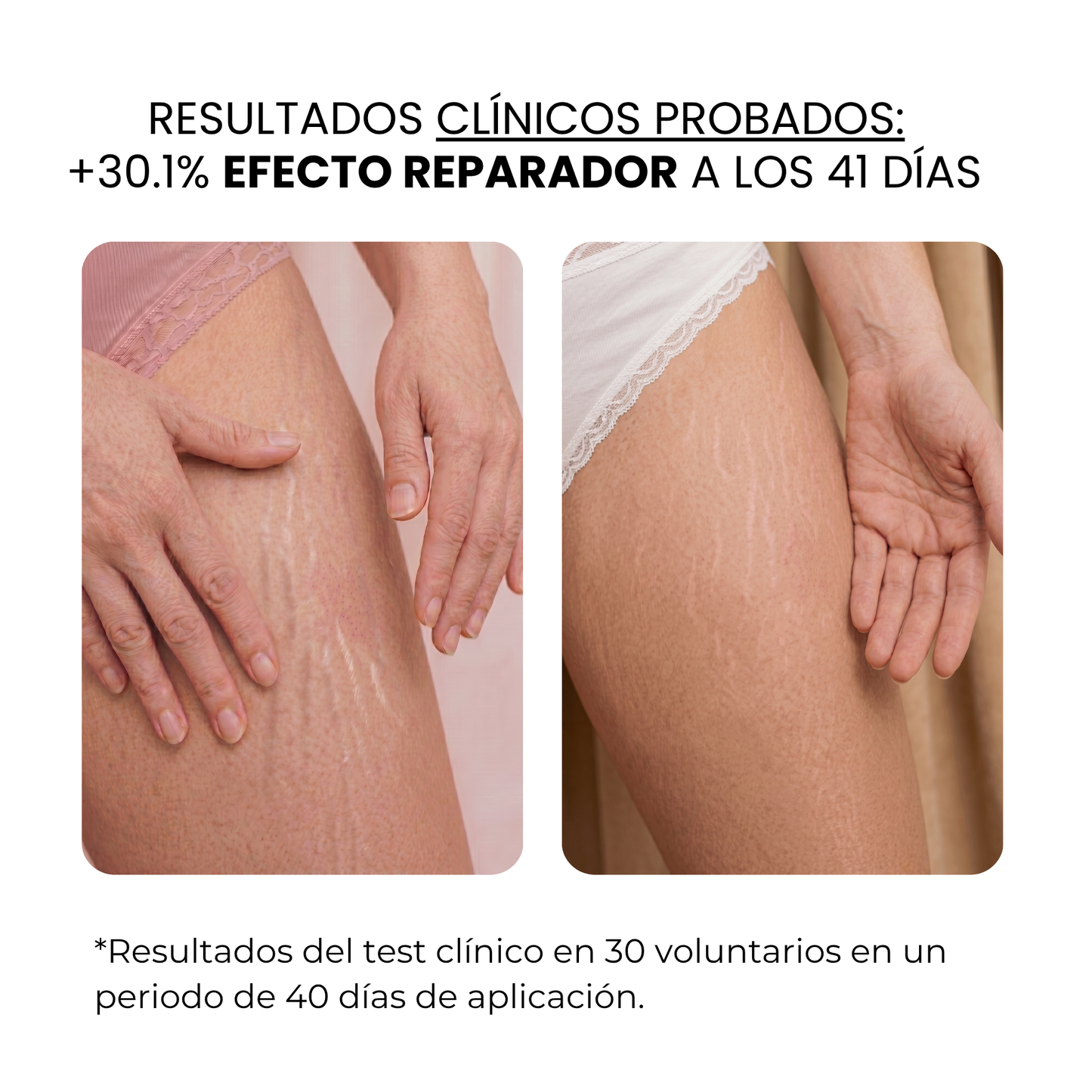 Tratamiento Anti Estrías | HAMINOS®