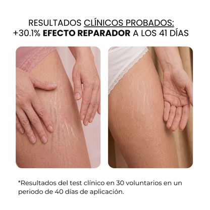Tratamiento Anti Estrías | HAMINOS®