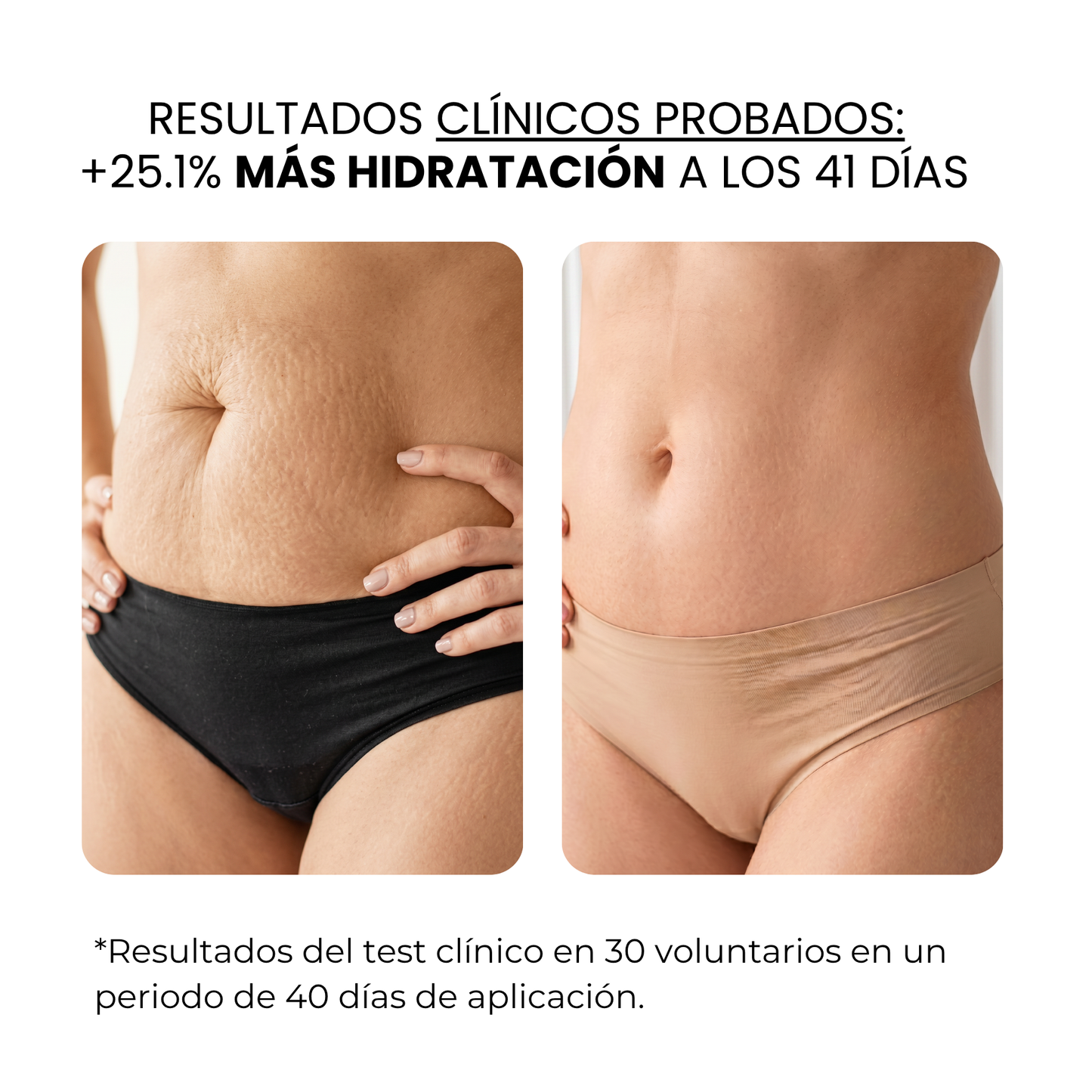 Tratamiento Anti Estrías | HAMINOS®