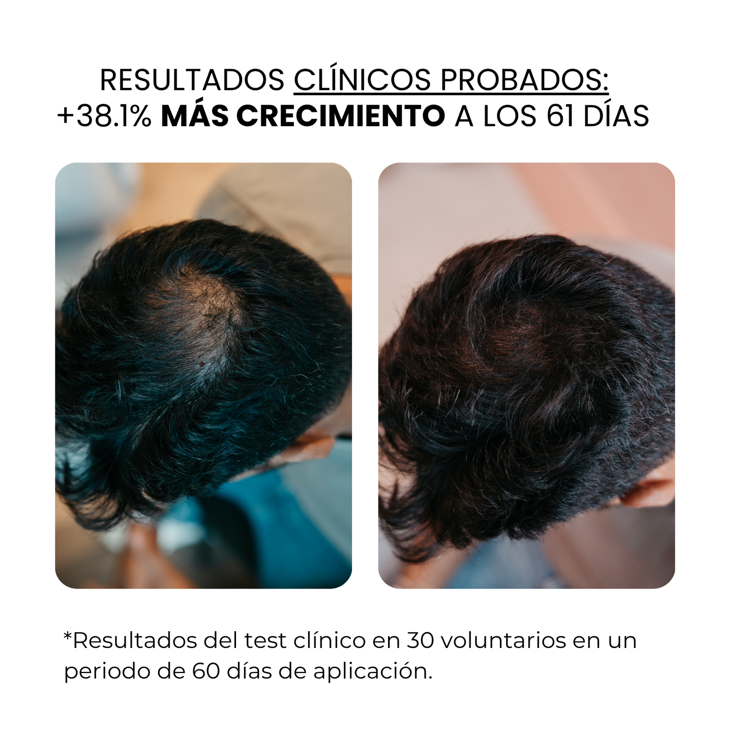 Tratamiento de Crecimiento Capilar y Barba | HAMINOS®